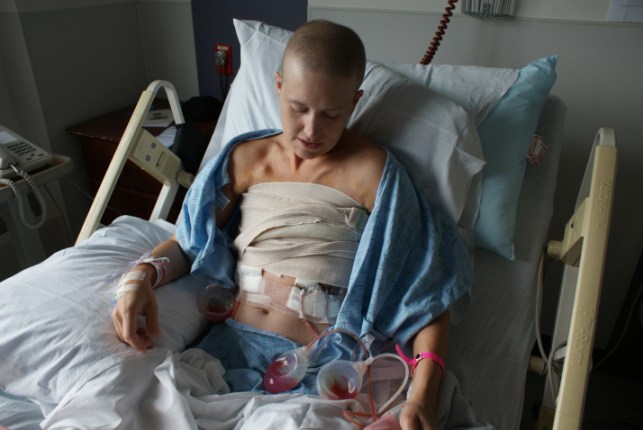 Me -- 5 Days post bilateral mastectomy and complete ALND (Axillary Lymph Node Dissection)