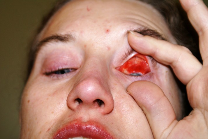 breast cancer thirties 30's 30s young eye infection infections red bloodshot lips