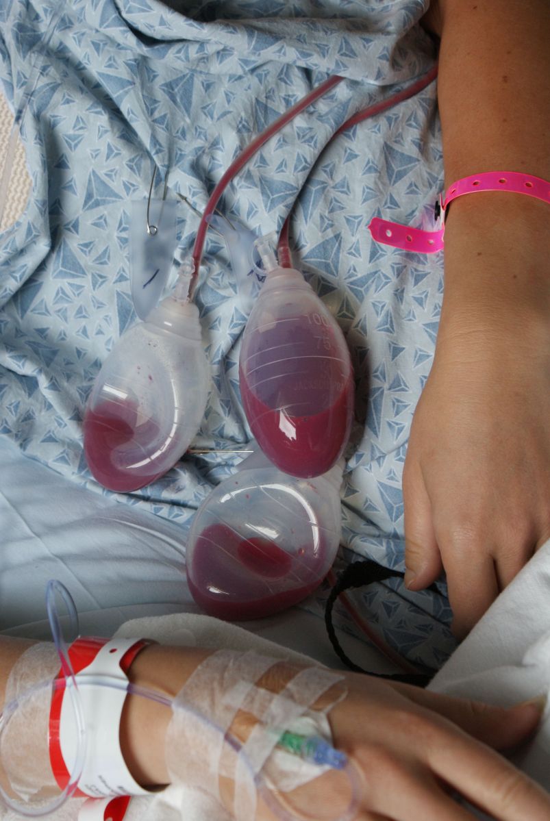 mastectomy drains cancer in my thirties cancerinmythirties.wordpress.com blood bilateral breast cancer