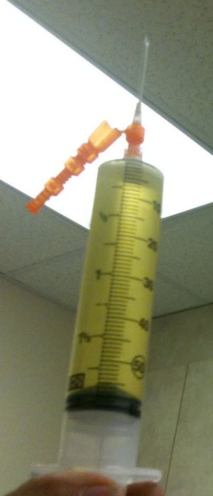 breast cancer young mom thirties 30s 30's mastectomy